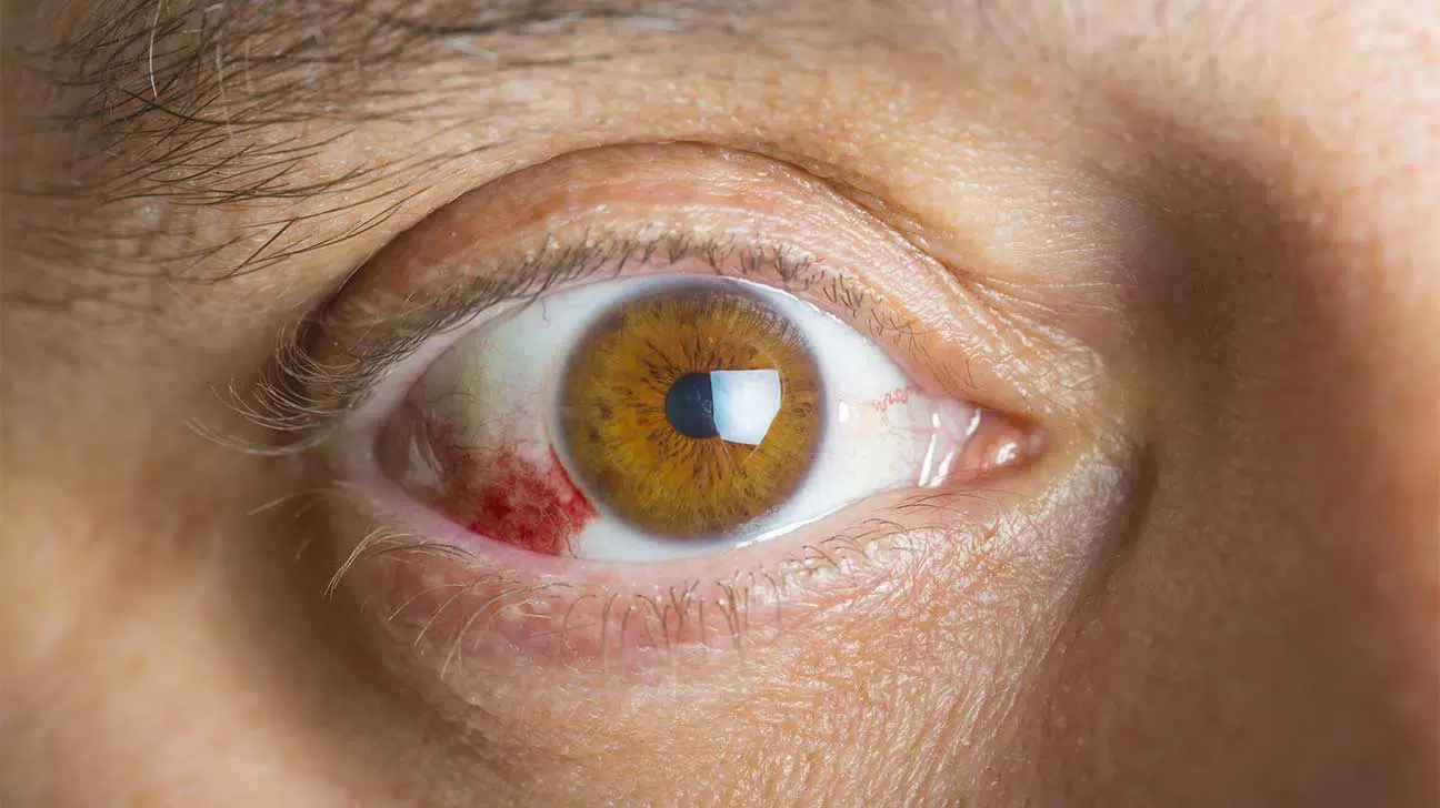 Corneal Ulcers From Cocaine Abuse